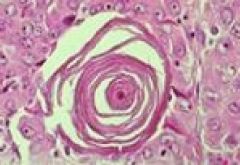 74-80% of all thyroid cancer

histology will show lots of psammmoma bodies = round collection of calcium, with empty looking nuclei that stain uniformly, aka orphan annie nuclei, 