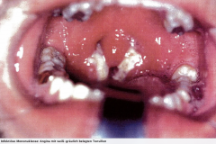 - Fieberhafte Angina tonsillaris (gerötete, vergrößerte Tonsillen mit weiß-gräulichen Belägen) oder Pharyngitis
- Generalisierte Lymphknotenschwellungen
Evtl. Organ-/Hautbeteiligung
- Aminopenicillingabe kontraindiziert!