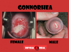 1. Gonorrhea is asymptomatic in up to 10% of carriers. These asymptomatic carriers can still transmit the disease. Most men have symptoms involving the urethra - e.g. purulent discharge, dysuria, erythema and edema of the urethral meatus, and freq...