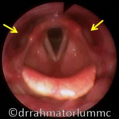 It's a pharyngeal recess within the thyroid lamina but lateral to paraglottic space