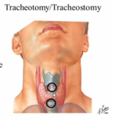 cricoidotomy because this area is above the thyroid.