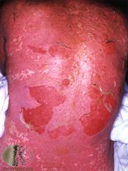 A few days after starting an anticonvulsant, several days of fever, cough, conjunctivitis, then abrupt painful red painful skin rash starting on the trunk and rapidly spreads.