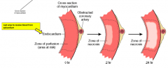 - Endocardium is furthest from coronary artery so is first to necrose
- Last epicardium (closest to coronary artery)
- Occurs in zone / area supplied by coronary artery