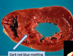 Dark red-blue mottling (due to stagnant blood)