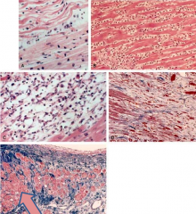 - Coagulative necrosis becomes well-established and ongoing
- Initially pyknotic nuclei, hyper-eosinophilic myocytes
- Followed by neutrophils (max 1-3 days), loss of nuclei  and striations
- By 7 days, macrophages are at border