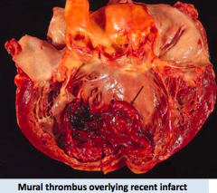 - Mural thrombi are thrombi adherent to the vessel wall
- They are not occlusive and affect large vessels, such as heart and aorta