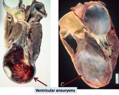- Ventricular aneurysm
- Progressive heart failure