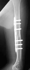Which of the following defines the working distance of a plate in a plate/screw fracture fixation construct?  
1.  The length of the interfragmentary lag screw
2.  The length between the 2 screws closest to the fracture on each end of the fractu...