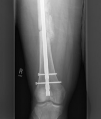 An adolescent patient is treated with a 6mm solid intramedullary nail. Compared to a 12mm solid nail of the same material, the 6mm nail has: 
1.  1/2 the torsional rigidity
2.  1/4 the torsional rigidity
3.  1/16 the torsional rigidity
4.  1/8...