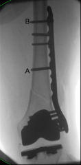 Figure A is a radiograph taken after an open reduction and internal fixation of a periprosthetic distal femur fracture. With this type of hybrid locked plate fixation, what is the difference between screw A and screw B?  
1.  Screw A can assist i...
