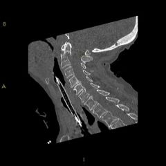 Type 2 Odontoid fracture with posterior displacement and angulation. This fracture pattern is at increased risk of nonunion compared with the other fracture patterns shown.Type 2 odontoid fractures are fractures which occur through the waist of th...