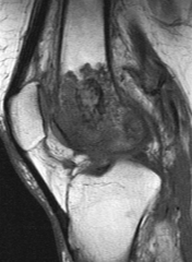 A 34-year-old man sustained a gunshot wound to the knee 18 months ago and was treated with bullet removal and a 10 day course of oral antibiotics. He now complains of 12 months duration of pain in the thigh and recent ulceration and drainage of th...