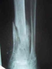 A 45-year-old homeless hemophiliac male presents with chronic tibial osteomyelitis. Which of the following factors has been shown to predict a better prognosis?  
1.  Polymicrobial infection
2.  Use of external fixation
3.  Infection with Methi...