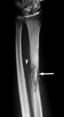 Success in the treatment of chronic tibial osteomyelitis is dependant on various factors including patient factors (immunocompetency of patient, nutritional status), injury factors (severity of injury as demonstrated by segmental bone loss), and i...