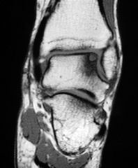 A 21-year-old male reports right ankle pain after sustaining an inversion ankle injury 2 years ago. He complains of mechanical symptoms with ankle movement that continue to be symptomatic with everyday activities. During his workup, an MRI shows a...