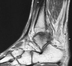 Lateral talar OCDs have an increased history of a traumatic etiology in comparision to medial talar OCDs. 

Lateral talar OCDs are also usually less common, smaller and more shallow than medial talar OCDS. Lateral talar OCDs are usually anterior...