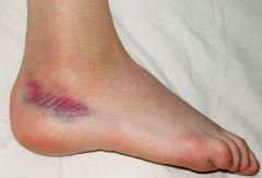 A 30-year-old professional ballet dancer presents with persistant ankle pain after an ankle sprain 6 months ago. Physical therapy and NSAID's have not alleviated the symptoms. Physical exam reveals some joint swelling but no ligamentous instabilit...