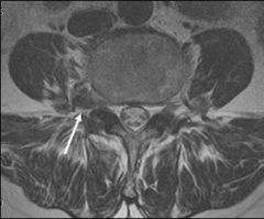 foraminal of far lateral disc herniation affects the exiting nerve root, while a paracentral or posterolateral disc herniation affects the traversing nerve root
L5 radiculopathy caused by a right paracentral disc herniation at L4/5 which is compr...