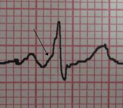 wolf parkinson white syndrome
- caused by an accessory pathway that connects atria to ventricles bypassing the av node
- has a short PR interval with a DELTA wave (P-R gradual up slope before the spike), and a wide >0.12s QRS complex
- can deve...