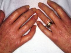 

Please look at the hands of this 50-year-old lady. She complains of tight, stiff fingers that turn white in the cold.



DX