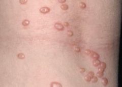  cutaneous viral infection caused by poxvirus
very common in childhood
small flesh-colored, pearly, dome shaped papules with central umbilication that usually occurs in moist areas such as the axillae, buttocks, and groin region
the papules sprea...