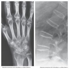 Caused by accelerated resorption of bone (bone destruction) - also caused by hormonal changes 


 


Deficiency of Calcium in Bone  - makes them more frail and easy to fx


 


Most common in postmenopausal females


 


Visualized...