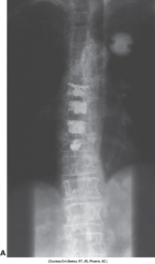 Done on 81 year old osteoportic woman to prevent vertebral collaspe