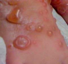 caused by a toxin-producing strain of S. aureus 
begins as red macules that progress to bullous (fluid-filled) eruptions on an erythematous base
lesions range from a few millimeters to a few centimeters in diameter
after the bullae rupture, a cle...