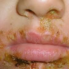 caused by both beta-hemolytic streptocccus and s. aureus
begins as papules that progress to vesciles and then to pustules measuring approximately 5 mm in diameter with a thin erythemaous rim
the papules rupture, leaving a honey-colored crust thin ...