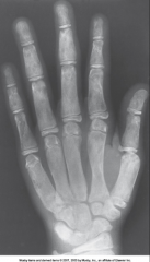 Disorder that begins during childhood - characterized by proliferation of fibrous tissue within the medullary cavity - proliferation causes loss of trabecular marks and widening of bones 


 


Occurs primarily in long bones and fractures eas...