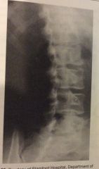 Which of the following is/are well demonstrated in the lumbar spine shown in fig 2-35
1. Zygapophyseal/apophyseal articulations
2. Intervertebral foramina
3. Inferior articular processes
A. 1 only
B. 1 and 2
C. 1 and 3
D. All three