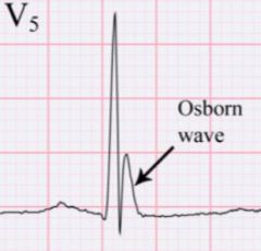 J-wave (osborn wave)


