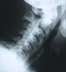 67yo M c/o chronic low & neck pain. lat cervical Fig A. thoracic spine Fig B & C. What is the most likely dx? 1-Ossification pos longitudinal lig; 2-rheumatoid arthts; 3-Ankylosing spndylitis; 4-DJD
5-DISH
