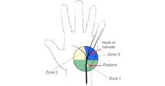 Zone 1 S&M (# ganglion)
Zone 2 M (# ganglion)
Zone 3 S (thrombosis)