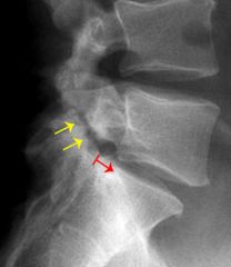 Low Grade L5-S1 isthmic spondylolisthesis w/ minimal sx. tx=obser w/ no restriction of activity. classically, gymnasts, football offensive lineman & athletes who do a lot of repetitive hyperextension activities, if sx then brace 6-12 wks no sports...