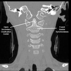 young boy is MVA & c/o  neck pain. CT is (-) for fx. Based on the presence of the ossification center in Fig A, what is the most likely age bracket of this pt? 1:< 1 yr; 2:1-3 yrs; 3:3-6 yrs; 4:8-10 yrs; 5: >12 yrs