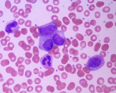 small number of blasts and promyelocytes seen; sometimes can look like reactive leukocytosis but other Dx tests (LAP, 15 etc) can help establish Dx