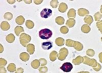 Enzyme found in mature  neutrophils
Activity is increased in neutrophilias related to infection and inflammation
Activity is increased during pregnancy
Activity is LOW in CML
Activity normal or increased in other CMPDs
Red staining indicates LAP acti