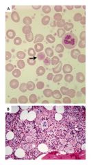 Increased platelets in blood
Increased megakaryocytes in bone marrow