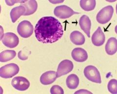 Production of blood cells outside the confines of the bone marrow
Most commonly spleen, but also liver, skin, lymph nodes
Not seen in acute leukemias or lymphoproliferative disorders
May develop in severe chronic hemolytic anemias, especially beta thal