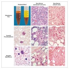 In P vera the increased Hct is remarkable. 
In Essential Thrombocytosis, the platelet count is remarkable. 
In Idiopathic (Primary) Myelofibrosis, the marrow is characteristically replaced by fibrous tissue; extramedullary hematopoiesis  occurs. Clues o