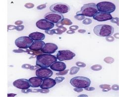 neoplastic blast cells appear homogenous and undifferentiated, actually they are a heterogenous collection that recapitulate the hierarchy of early precursor cells in blood cell differentiation

only a small subgroup retains the capacity to proliferate 