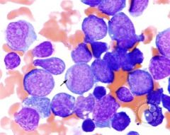 aberrant primary granules with MPO activity, not specific for a particular FAB M type or genetic finding, but indicate a NON-lymphoid leukemia and neoplastic process