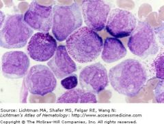 t15;17 defines the category
Predominant cell is the promyelocyte
Neoplastic promyelocytes contain thromboplastin-like substance in granules: DIC is additional problem.
Prognostic category: Intermediate