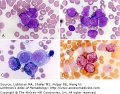 Neoplastic population: a mixture of immature cells with myeloid features (myloperoxidase (MPO) + and chloroacetate esterase +) and cells with monocytic features (non-specific esterase +).
Prognostically heterogeneous
Includes favorable, intermediate and