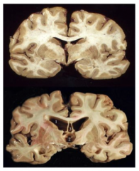 Chronic Traumatic Encephalopathy (CTE)

Anatomical changes