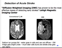 Detection of Acute Stroke