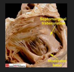 The septomarginal trabecula (also known as moderator band) is a muscular band of heart tissue found in the right ventricle. It is well-marked in sheep and some other animals, and frequently extends from the base of the anterior papillary muscle to the ven