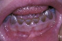 in conjunction with osteogenesis imperfecta
enamel is normal 
defect in dentin - opalescent teeth