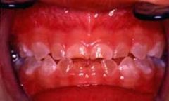 Dentinogenesis imperfecta, Shields type II